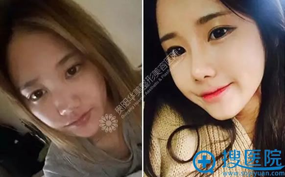 贵阳华美玻尿酸隆鼻案例图 贵阳华美玻尿酸隆鼻案例图