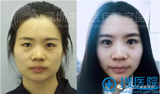 <!--<i data=20240710 data-id=12145></i>-->韩式双安排+玻尿酸丰面部案例 <!--<i data=20240710 data-id=12145></i>-->韩式双安排+玻尿酸丰面部案例