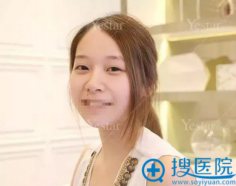 艺星双眼皮手术术前照 艺星双眼皮手术术前照