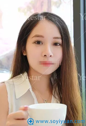 开扇形双眼皮术后1个月恢复效果 开扇形双眼皮术后1个月恢复效果