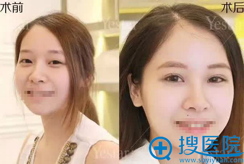 艺星双眼皮手术前后对比照片 艺星双眼皮手术前后对比照片