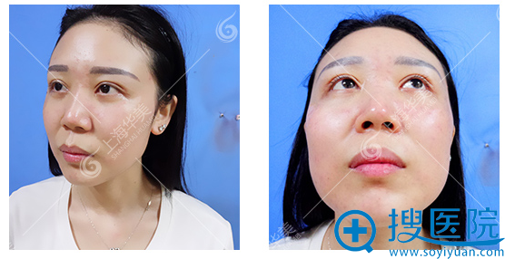 看了上海华美整形医院张朋主任的隆鼻案例后果断找他做了鼻综合