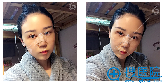 来上海华美做完鼻综合5天了 来上海华美做完鼻综合5天了