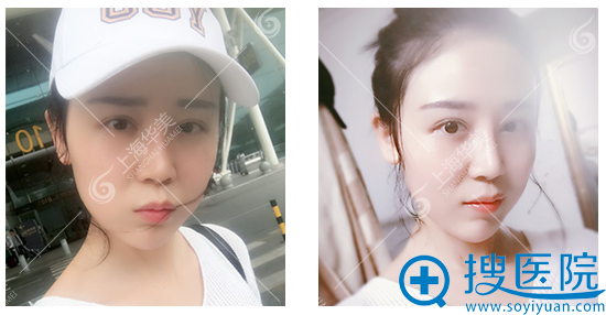找张朋主任做鼻综合术后3周了 找张朋主任做鼻综合术后3周了