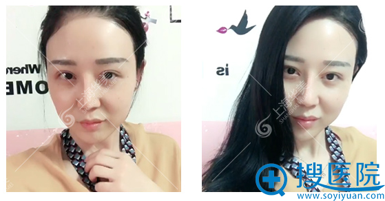 上海华美鼻综合+28天效果 上海华美鼻综合+28天效果