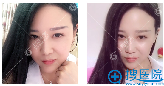 在上海华美做隆鼻+3个月生活照 在上海华美做隆鼻+3个月生活照