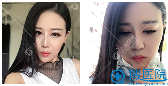 张朋主任鼻子+瘦脸4个月自拍 张朋主任鼻子+瘦脸4个月自拍