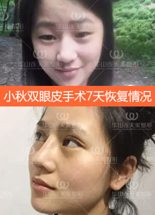 小秋公开在杭州连天美找姜鑫利做双眼皮术后7天恢复情况
