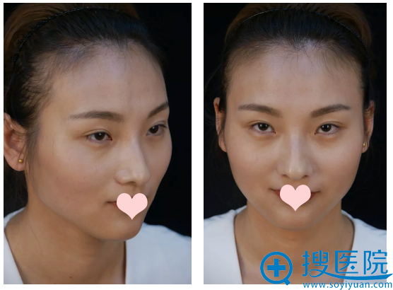 看我找上海薇琳医美孙荣院长做的自体脂肪填充全脸案例图怎么样