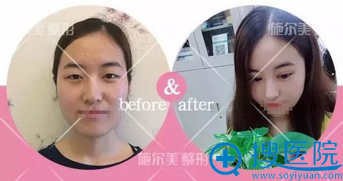 扬州施尔美韩永强美东方芭比眼综合手术助力你的美丽蜕变