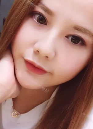 北京西美整形做完开眼角和双眼皮手术 从此单眼皮变洋娃娃