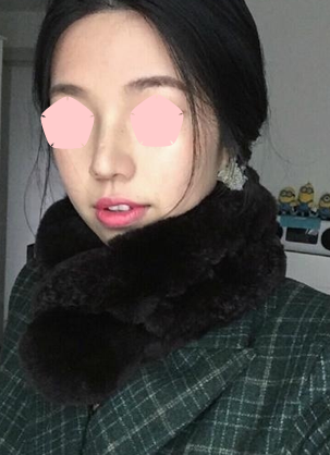记录短塌鼻女孩在广州时光整形医院做鼻综合恢复期照片