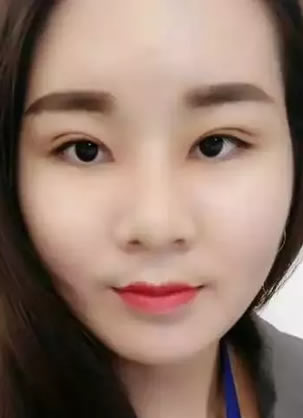 找北京伊美尔黄志祥做的面部吸脂手术1个月恢复过程及效果图