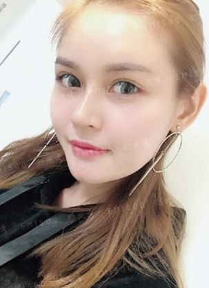 快来看我刚做完自体脂肪面部轮廓填充恢复效果及前后对比图