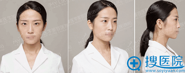 四川美莱夏秋线雕隆鼻+玻尿酸面部填充手术15天恢复日记