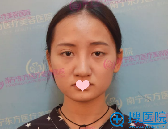 广西隆鼻哪里好?南宁东方整形医院鼻综合修复案例过程图片分享