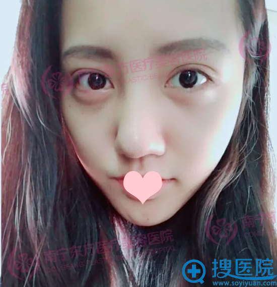 郑州东方鼻综合第17天恢复期自拍 郑州东方鼻综合第17天恢复期自拍