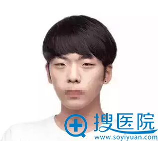 大连瑞丽双眼皮+隆鼻术后效果证明男生整容比女生更加惊艳