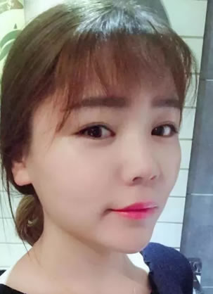 25岁被叫阿姨的她在福州美莱做完纳米脂肪移植摇身变少女脸