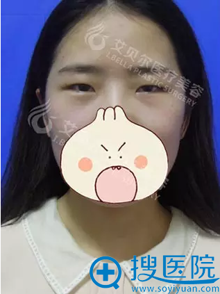 <!--<i data=20240710 data-id=8113></i>-->石东文双眼皮+开眼角术前照 <!--<i data=20240710 data-id=8113></i>-->石东文双眼皮+开眼角术前照