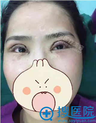 石东文切开双眼皮+开内眼角术后即刻 石东文切开双眼皮+开内眼角术后即刻