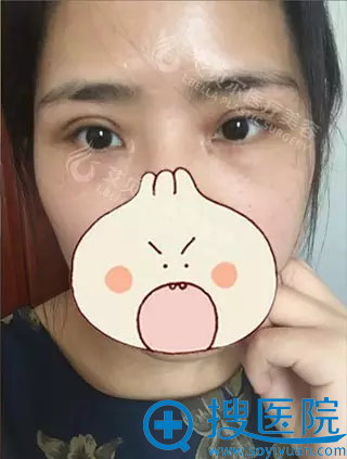 <!--<i data=20240710 data-id=8113></i>-->切开双眼皮拆线后效果 <!--<i data=20240710 data-id=8113></i>-->切开双眼皮拆线后效果