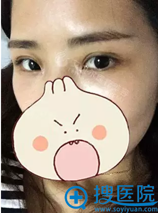 <!--<i data=20240710 data-id=8113></i>-->双眼皮+开眼角术后30天效果 <!--<i data=20240710 data-id=8113></i>-->双眼皮+开眼角术后30天效果
