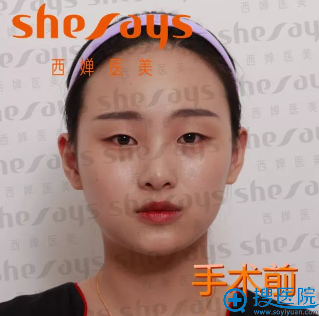 双眼皮术前照片 双眼皮术前照片