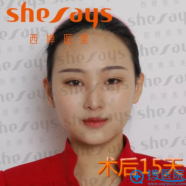 8mm平行双眼皮术后15天效果图 8mm平行双眼皮术后15天效果图