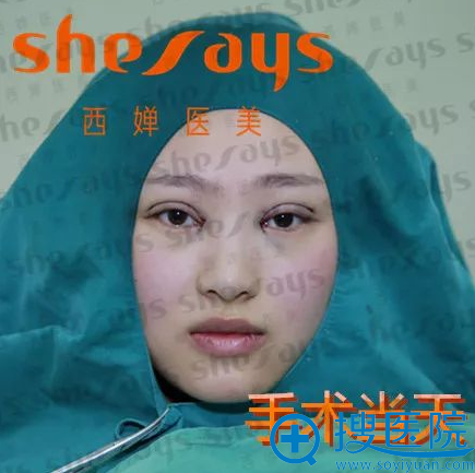 <!--<i data=20240710 data-id=13393></i>-->聂晶莹欧式大平行双眼皮即刻效果 <!--<i data=20240710 data-id=13393></i>-->聂晶莹欧式大平行双眼皮即刻效果