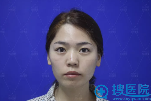 看杭州美莱李波为我做的全脸自体脂肪填充效果怎么样
