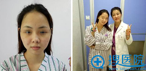 深圳晨曦朱春艳鼻综合+假体下巴术后3个月效果自然不夸张