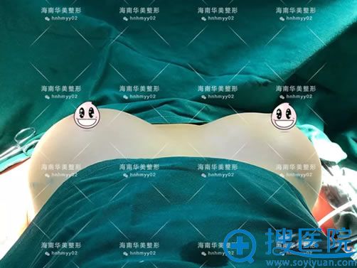 假体隆胸手术即刻的效果图 假体隆胸手术即刻的效果图
