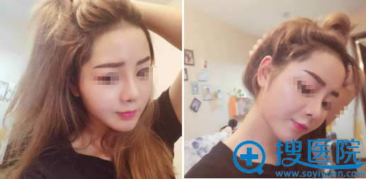朱春艳鼻综合+假体隆下巴术后3个月恢复效果 朱春艳鼻综合+假体隆下巴术后3个月恢复效果