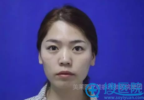 君君做自体脂肪填充前的照片 君君做自体脂肪填充前的照片