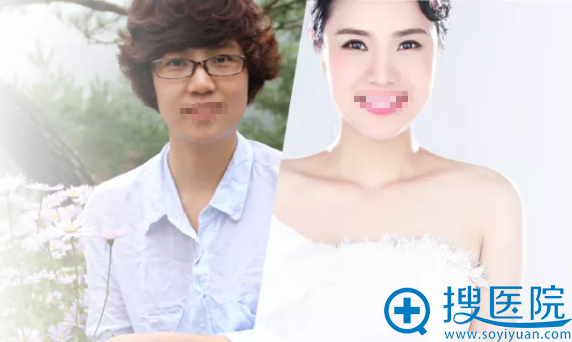 西安傲丽隆鼻+面部脂肪填充术后三十天从黄脸婆蜕变为气质女