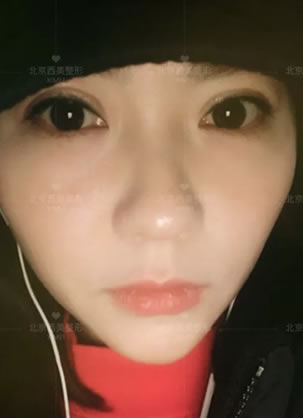 在北京西美做非手术双眼皮和开眼角手术成功变大眼睛的经历