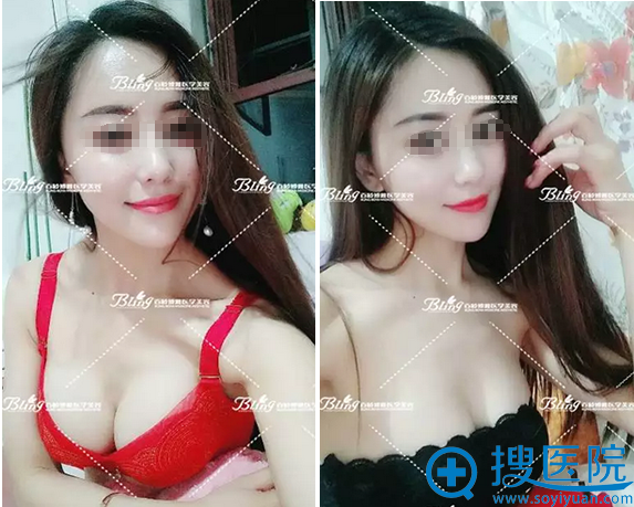 220CCˮ���μ�������2���»ָ�Ч��