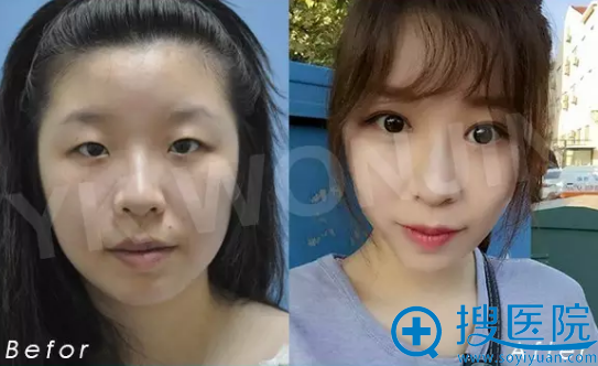 <!--<i data=20240710 data-id=13098></i>-->医院朴成浩院长双眼皮案例 <!--<i data=20240710 data-id=13098></i>-->医院朴成浩院长双眼皮案例