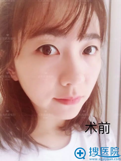 姑娘做双眼皮手术前的照片 姑娘做双眼皮手术前的照片