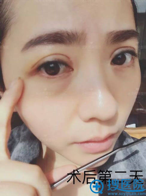双眼皮手术第2天 双眼皮手术第2天
