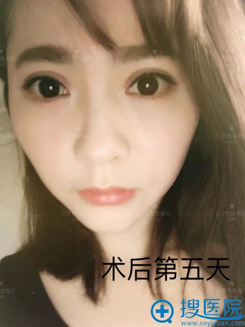 双眼皮和开眼角术后5天照片 双眼皮和开眼角术后5天照片