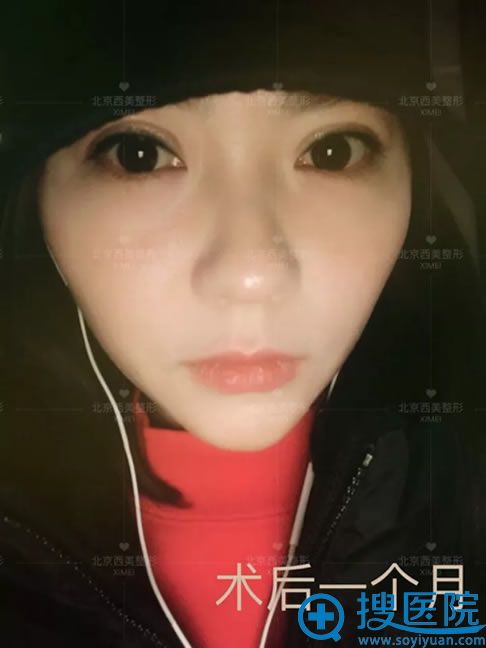 做完双眼皮变大眼睛的照片 做完双眼皮变大眼睛的照片