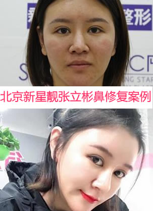北京新星靓案例:鼻假体外漏修复手术过程及恢复效果图