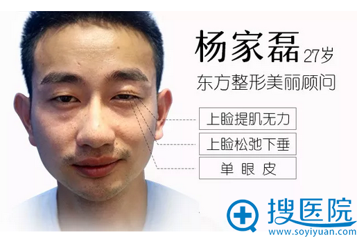 双眼皮术前照片 双眼皮术前照片