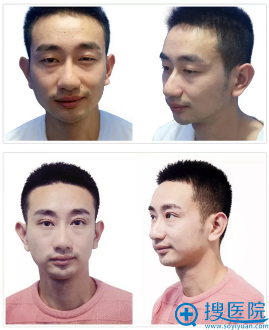 温州东方整形医院孙华刚双眼皮案例对比图 温州东方整形医院孙华刚双眼皮案例对比图