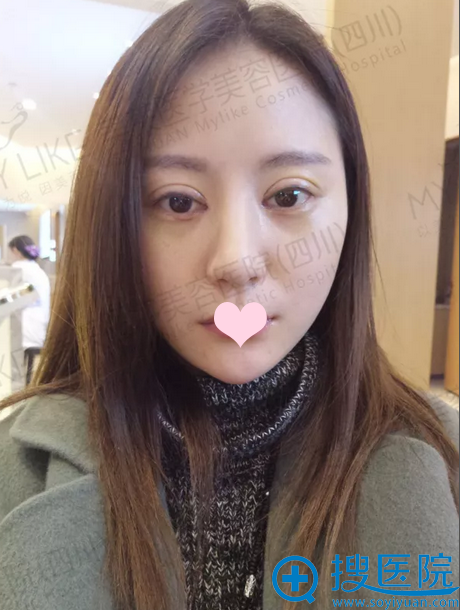 术后一个月,双眼皮恢复的超自然 术后一个月,双眼皮恢复的超自然