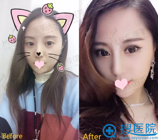 韩国栋双眼皮案例前后对比图 韩国栋双眼皮案例前后对比图