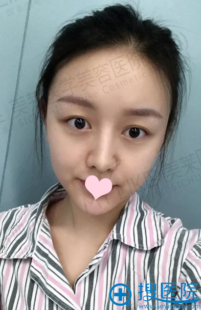 双眼皮术前照 双眼皮术前照