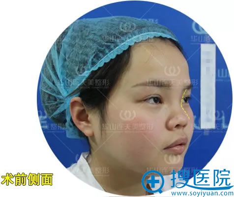 安琪做鼻综合整形前的照片 安琪做鼻综合整形前的照片